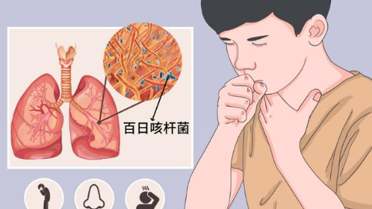 卷土重来的百日咳成人照样中招�? title=